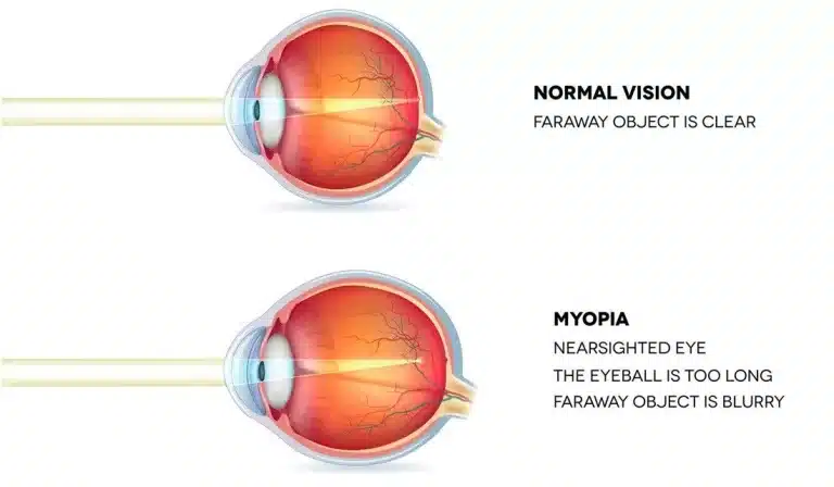 Myopia and Its Long-Term Impact