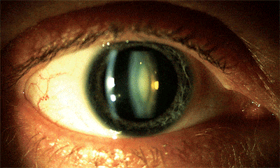 The Connection Between Myopia and Cataracts and How One Condition Influences the Other